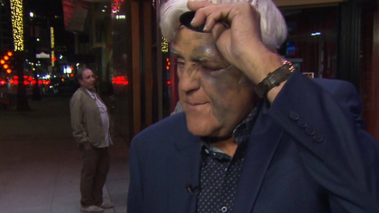 Jay Leno Is All Black And Blue With Severe Bruises And Injuries After